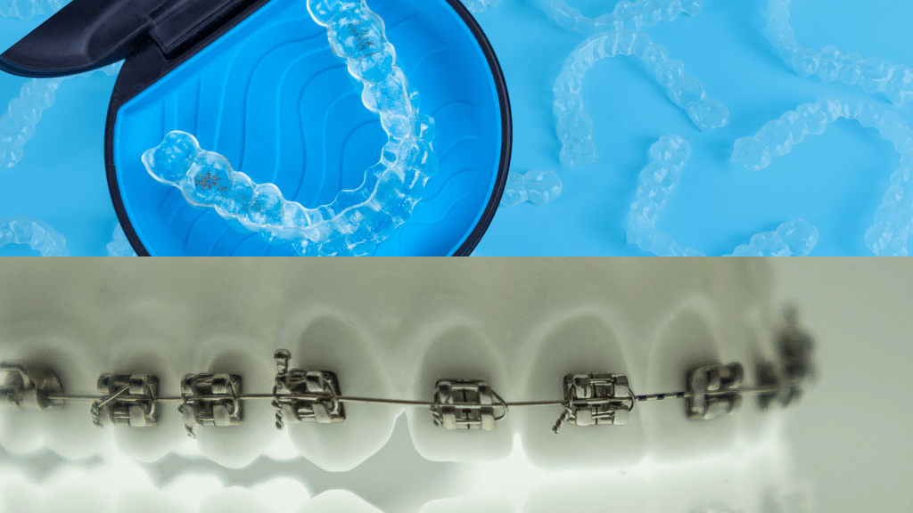 invisalign-o-brackets