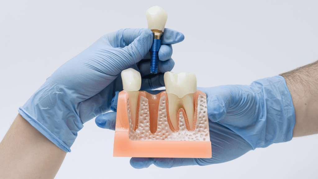 implante-dental-en-las-palmas
