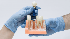 implante-dental-en-las-palmas